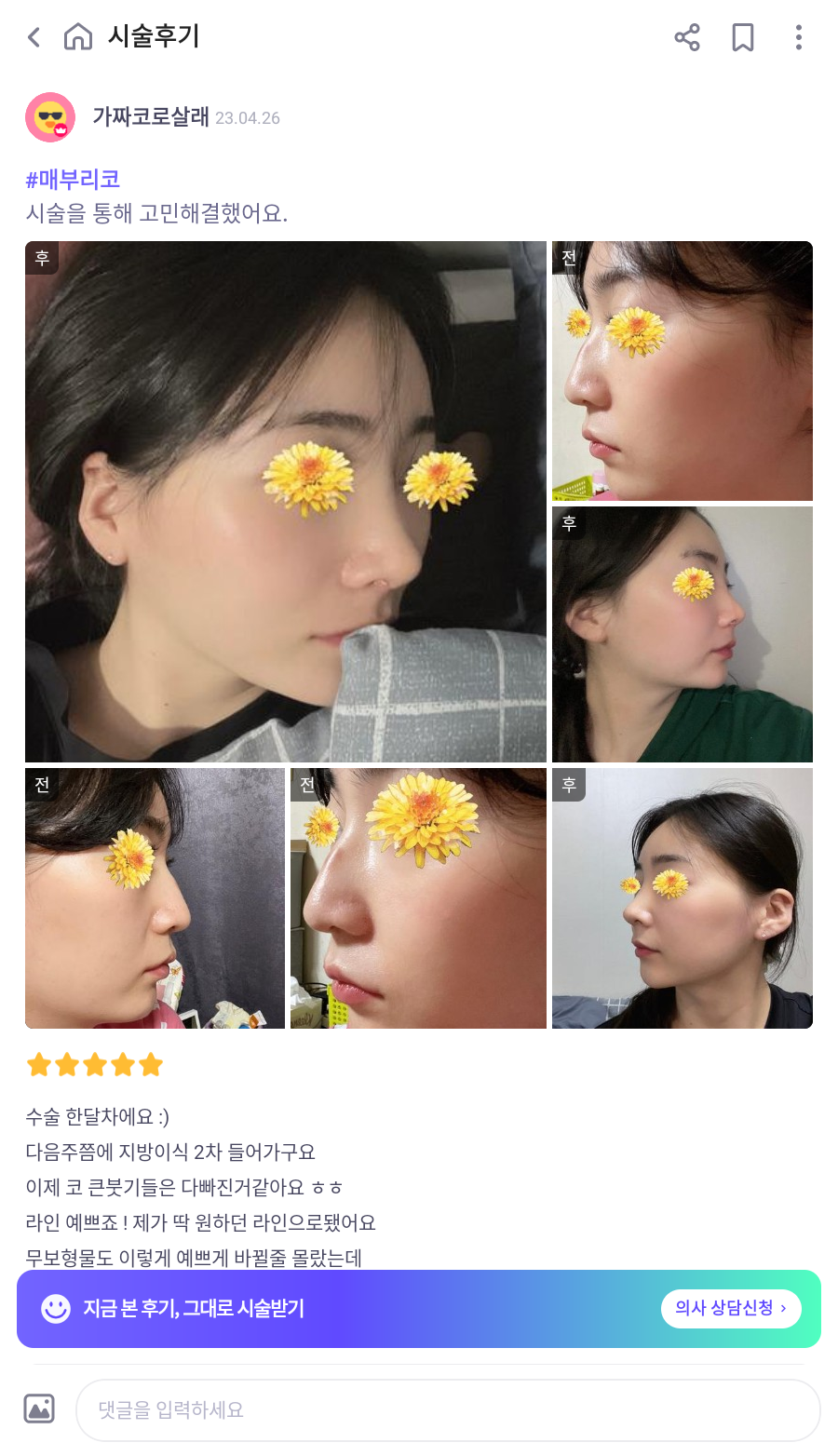 여자매부리코와 화살코 교정을 코원성형외과에서 하고 딱 원하는 라인을 찾게 되었어요! 관련 이미지 7