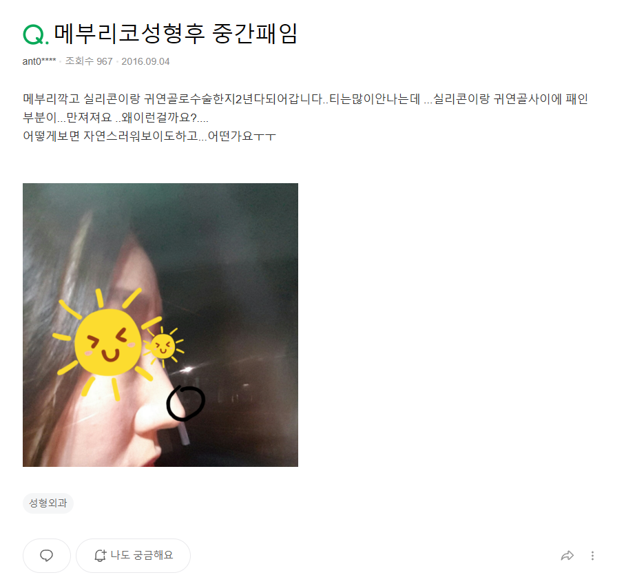 Q. 매부리코 수술 부작용이 걱정될 때 확인할 점 알아보기 관련 이미지 2