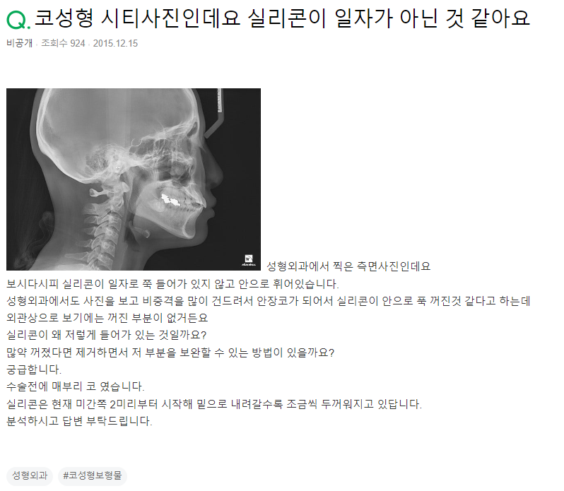 Q. Silicone Sinking After Hump Nose Surgery (CT Photo Attached) image 2