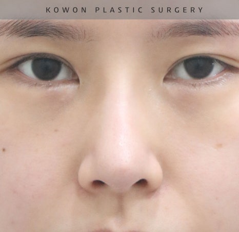 과도하게 화려한코, 귀연골에 비중격코수술로 자연스럽게 개선 됐어요! 관련 이미지 11