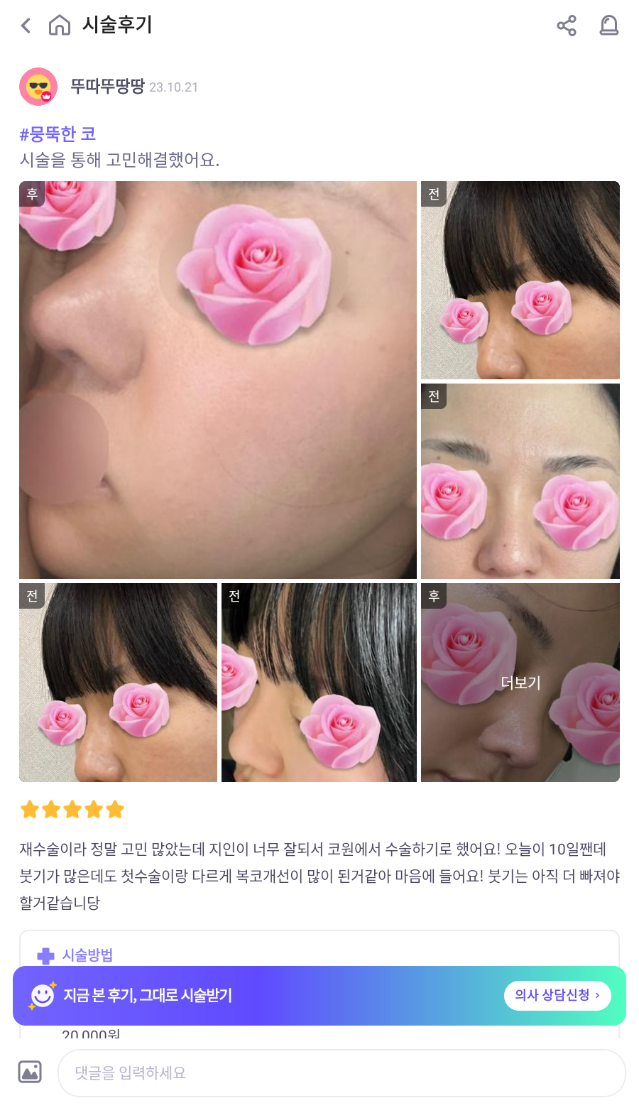 This is a review of nose surgery for a bulbous nose using donated rib cartilage at Kowon Plastic Surgery! image 9