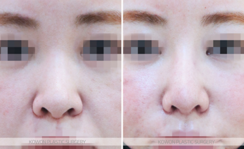 Natural Nose Line Improvement Process Seen Through Changes Before and After Cartilage Stitching at the Nasal Tip image 7