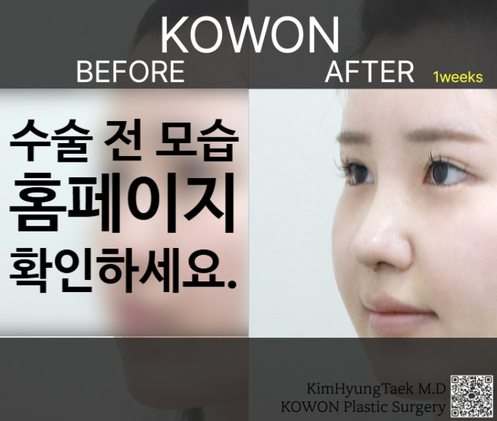 긴코성형, 매부리와 휜코까지 동시에 개선하는 코원성형외과의 노하우 관련 이미지 4