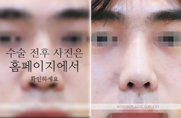 남자매부리코 교정, 비중격만곡증까지 함께 고려해야 하는 이유 관련 이미지 5