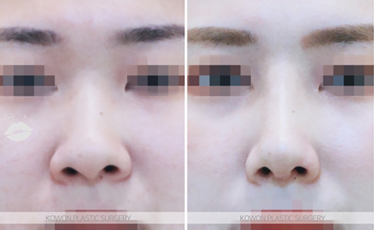 Q. Worried about inflammation after nose surgery, is severe pain after suture removal normal? image 7