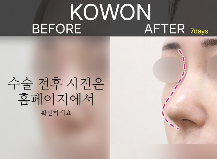 여자매부리코, 복코까지 함께 고려해야 하는 3가지 이유 관련 이미지 8