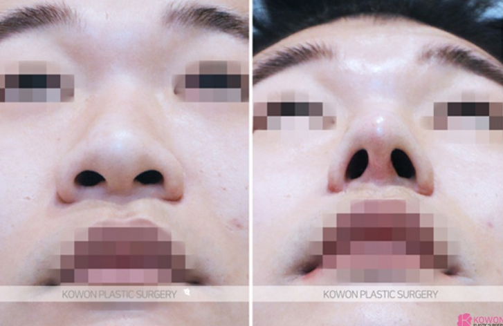 Q. Cartilage Pain After Nose Surgery: Is It a Side Effect of Male Rhinoplasty? Causes and How to Handle It image 6