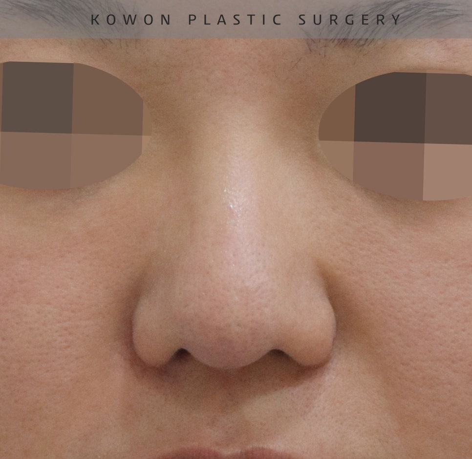 This is a review of nose surgery for a bulbous nose using donated rib cartilage at Kowon Plastic Surgery! image 13
