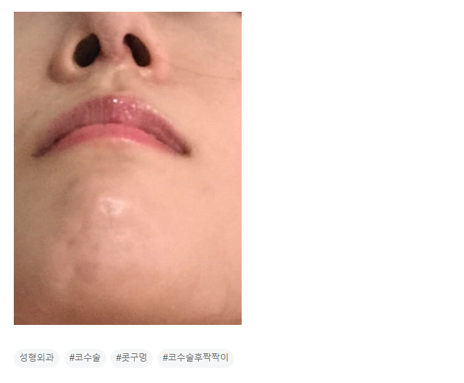 Q. I had nose surgery, but my eyes and nostrils are uneven... image 3