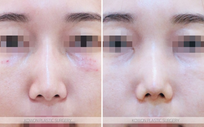 What Is Refined Natural Nose Surgery? Check This If You’re Considering Small Nose Surgery image 9