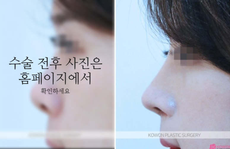 작은코성형에서 입체감 있는 코 라인을 만드는 핵심 3가지 관련 이미지 6