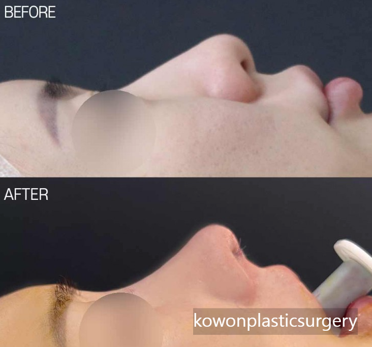 Natural Nose Line Improvement Process Seen Through Changes Before and After Cartilage Stitching at the Nasal Tip image 2