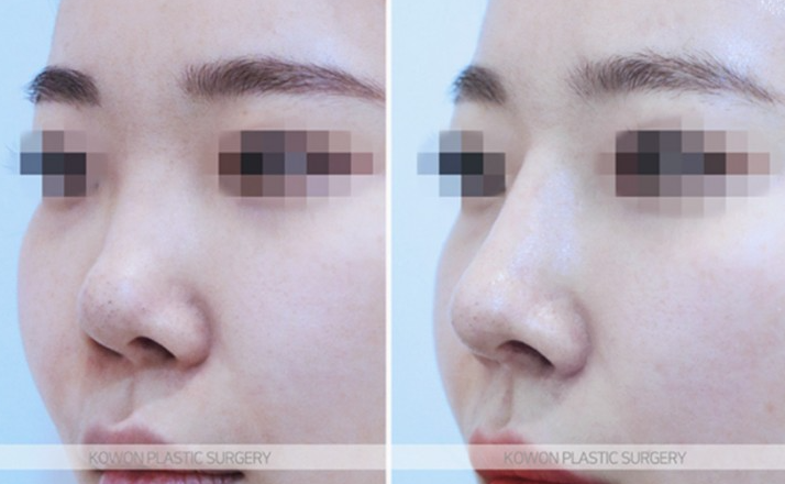 Q. If You’re Considering Revision Rhinoplasty image 9