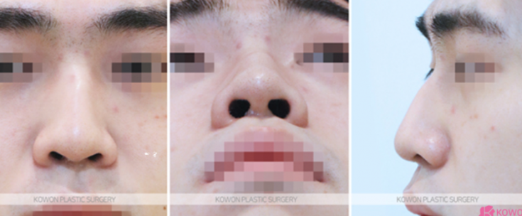 Q. The three-dimensional look that changes before and after male nose surgery: What changes are possible with male nose surgery? image 4