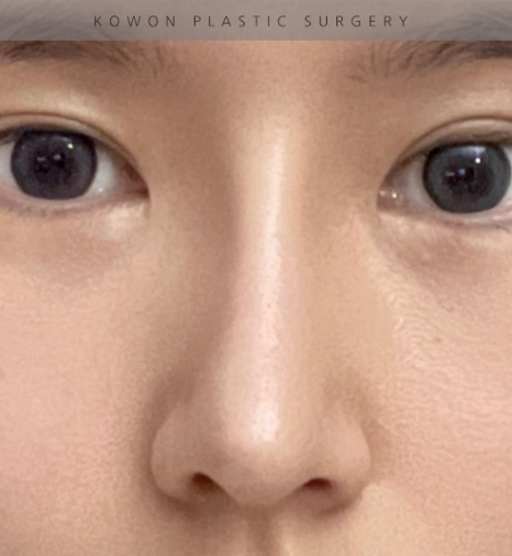 과도하게 화려한코, 귀연골에 비중격코수술로 자연스럽게 개선 됐어요! 관련 이미지 6