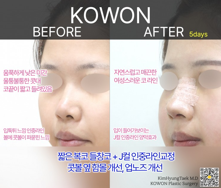 Q. If you're worried about revision rhinoplasty after upturned nose surgery? image 7