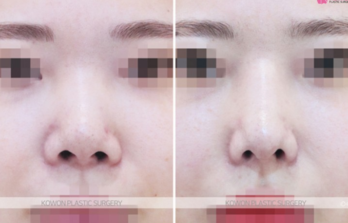 Q. I had nose surgery. Is this a complication? I’m wondering if I need revision rhinoplasty image 6