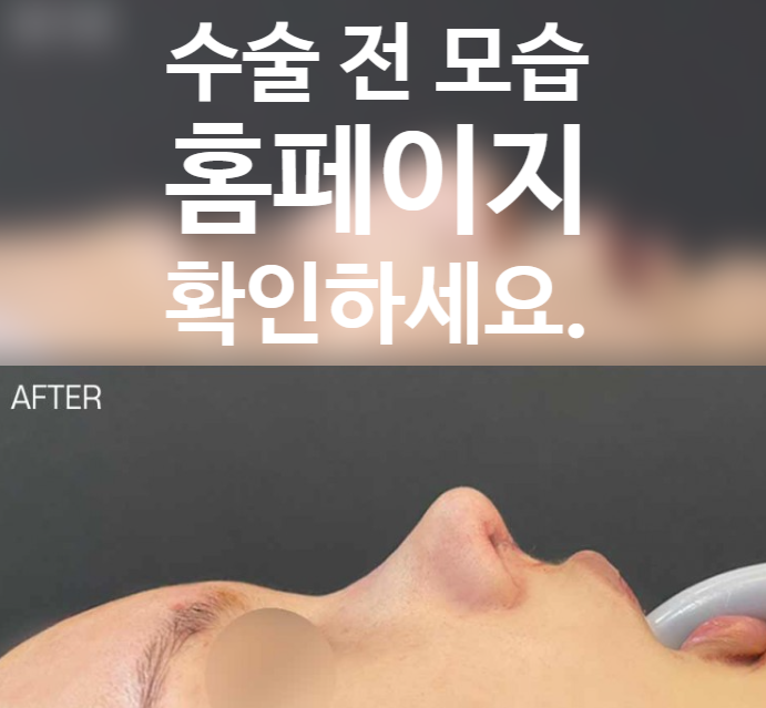 매부리 개선과 코끝 묶기 과정을 통해 완성된 코원성형외과의 자려한 라인 변화 관련 이미지 2