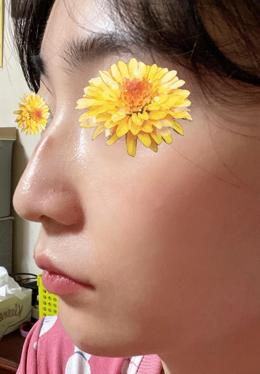 여자매부리코와 화살코 교정을 코원성형외과에서 하고 딱 원하는 라인을 찾게 되었어요! 관련 이미지 3