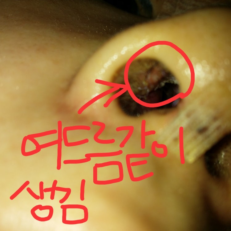 Q. 코안 여드름, 코성형 염증이면 코수술항생제 처방받아야 하나요? 관련 이미지 3