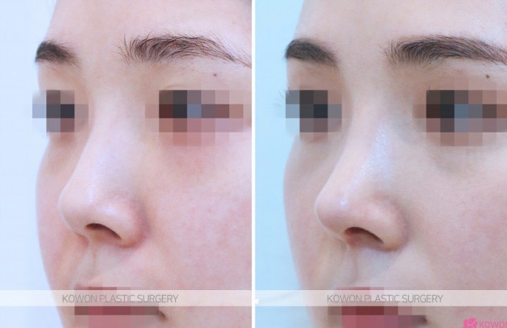 Q. Nasal Surgery Swelling: Is the Swelling on the Bridge of the Nose Due to Infection After Nose Surgery? image 5