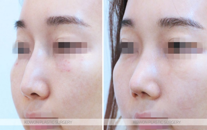What Is Refined Natural Nose Surgery? Check This If You’re Considering Small Nose Surgery image 7