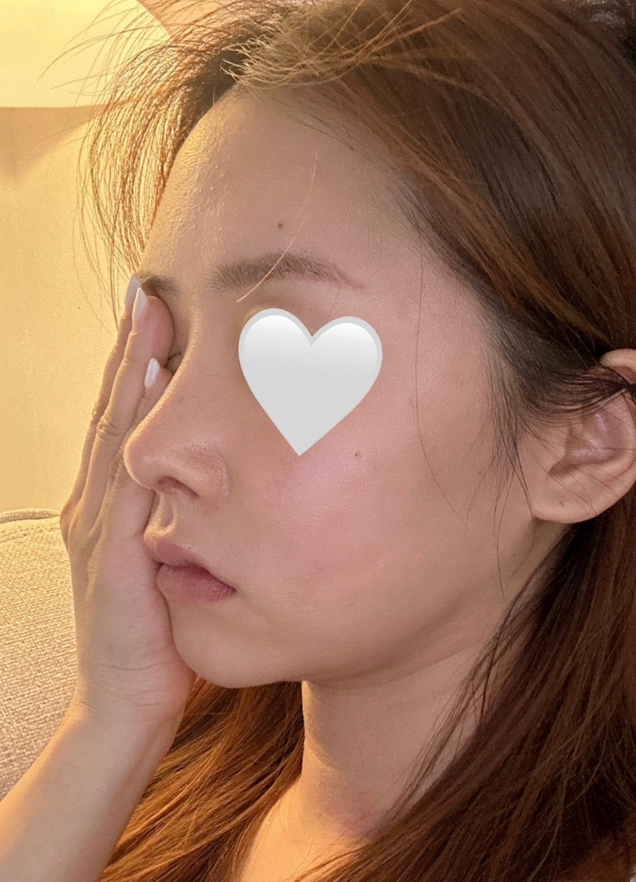 Revision Rhinoplasty Using Autologous Rib Cartilage, I Resolved My Concerns Through Surgery! image 3