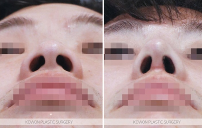 Q. 자가늑코수술 맞춤보형물로 자가조직코성형 하는 게 더 낫나요? 관련 이미지 5