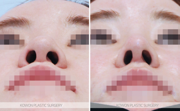 Q. I’m wondering whether my nose surgery swelling period needs more time to look natural, or whether revision surgery is necessary. image 5
