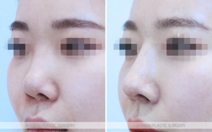 Q. I’m 고민 whether this is a side effect of cartilage nose surgery after revision rhinoplasty near Sinsa Station image 5