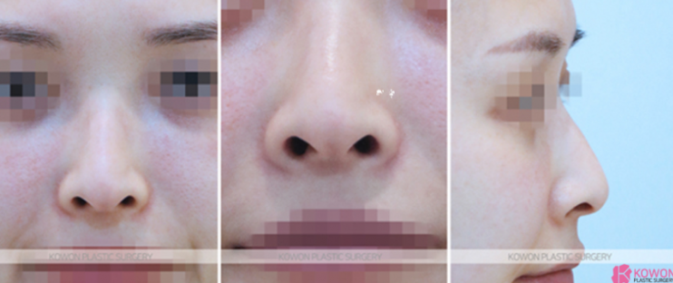 Q. I’m worried that a 4 mm silicone implant for a nose bridge augmentation will look obvious image 4
