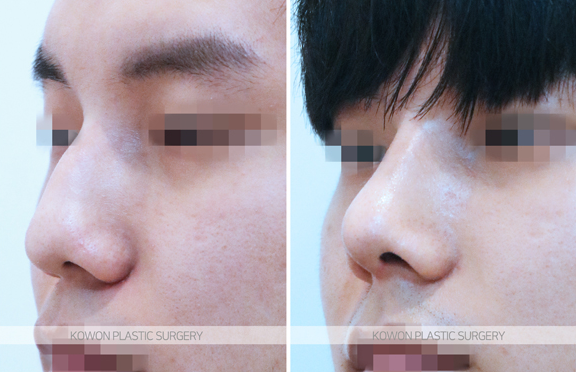 What Are the Criteria for Choosing a Good Place for Men’s Rhinoplasty? A Summary of Changes Before and After a Hump Nose Correction image 7