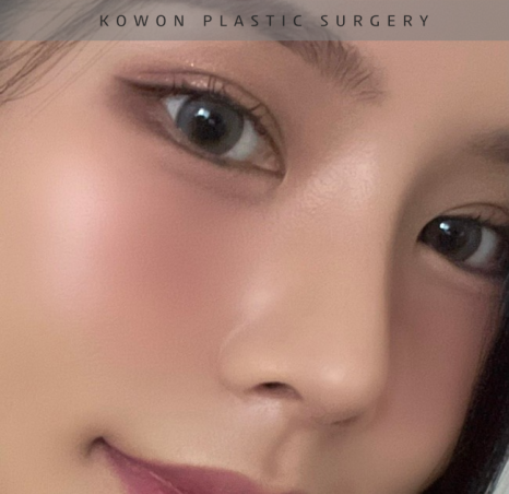 과도하게 화려한코, 귀연골에 비중격코수술로 자연스럽게 개선 됐어요! 관련 이미지 27