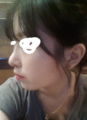 Q. After surgery for an upturned nose, it became a hooked nose. What is the solution? image 5