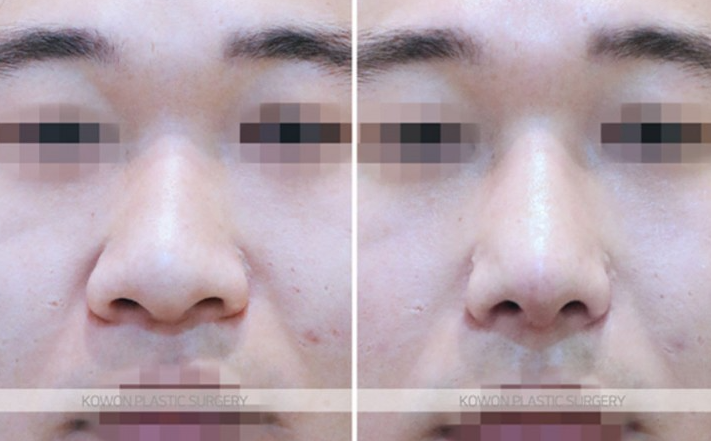 주먹코 수술 언제 자연스러워지나요? 직후 변화와 회복기간 정리 관련 이미지 6