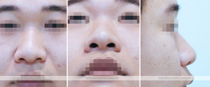 주먹코 수술 언제 자연스러워지나요? 직후 변화와 회복기간 정리 관련 이미지 4