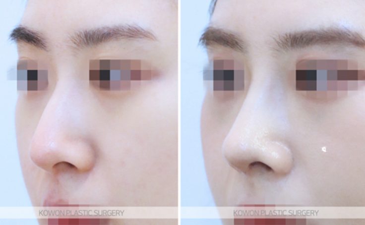 Q. I’m asking because I’m worried about complications after tip surgery and the duration of non-incisional alar reduction. image 6