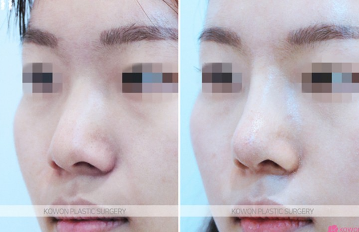 Q. Noble Surgery Implant Effect: The Swelling Period Has Passed, But... image 5