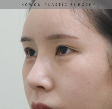 과도하게 화려한코, 귀연골에 비중격코수술로 자연스럽게 개선 됐어요! 관련 이미지 16