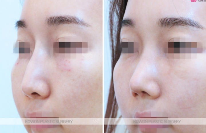 Q. Considering Surgery for the Bridge Between the Eyebrows and the Nose: Side Effects of Nasal Bridge Surgery and Key Points for Revision Surgery image 8