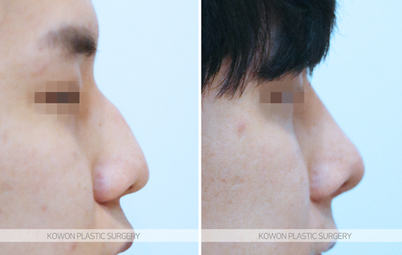 What Are the Criteria for Choosing a Good Place for Men’s Rhinoplasty? A Summary of Changes Before and After a Hump Nose Correction image 8