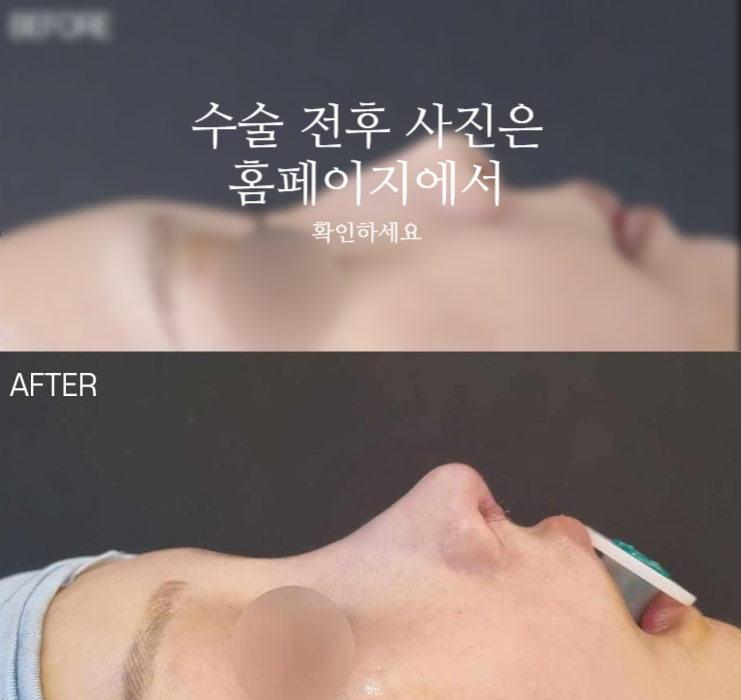 작은코성형에서 입체감 있는 코 라인을 만드는 핵심 3가지 관련 이미지 2