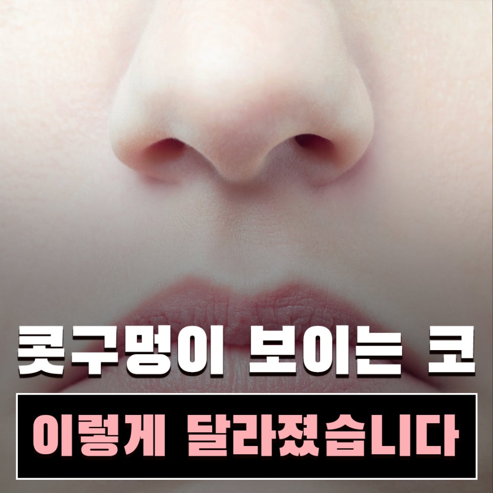 콧날개수술, 단순히 콧볼만 줄이는 수술일까요? | 코원성형외과 관련 이미지 1