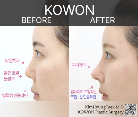 코원성형외과 코재수술성형외과에서 자가늑코재수술로 원하는 코를 주셨어요! 관련 이미지 18