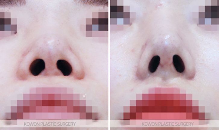 Q. Why Do the Nostrils Look Uneven After Revision Nose Surgery with Ear Cartilage? image 7