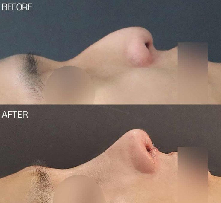 Correcting a Hump Nose and Positive Changes in the Nose Tip Line Shown in Before-and-After Male Rhinoplasty Photos image 2