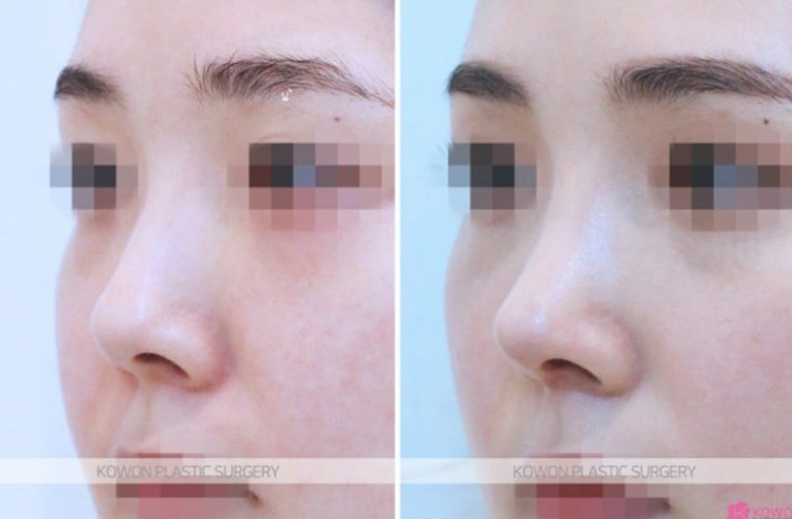 Q. I’m uncomfortable with swelling and nose pain after rhinoplasty due to a nasolabial fold implant image 4
