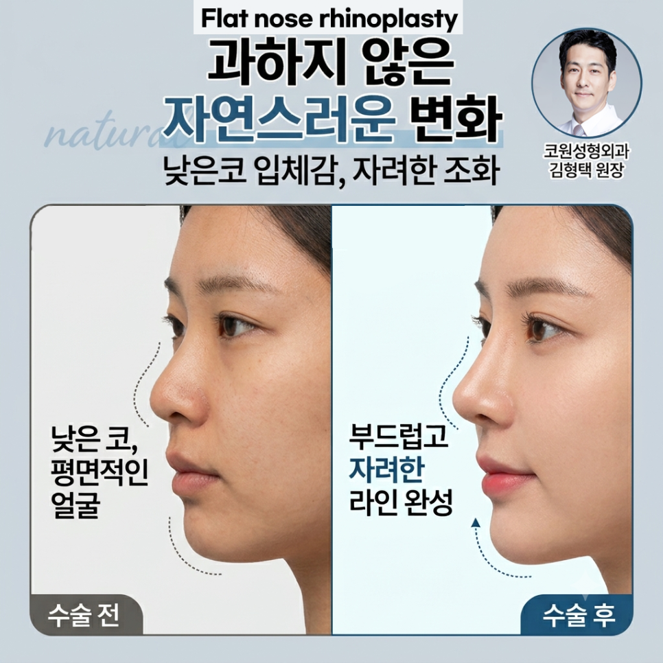 낮은코 성형 과하지 않은 높이와 부드러운 라인을 고려한 코원성형외과 사례 관련 이미지 1