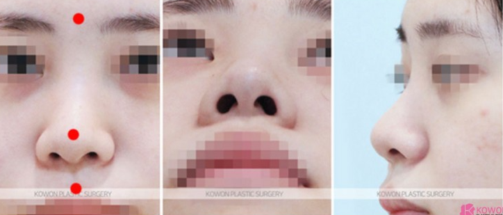 Q. Can I Have a Non-Implant Nose Surgery Along with Changes Before and After Bulbous Nose Surgery? image 3