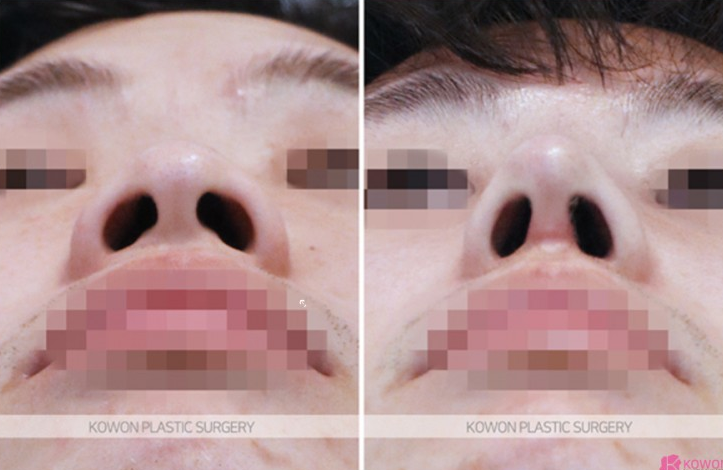 Q. My nose looks artificial because of swelling after bulbous nose surgery. Should I get revision rhinoplasty? image 8